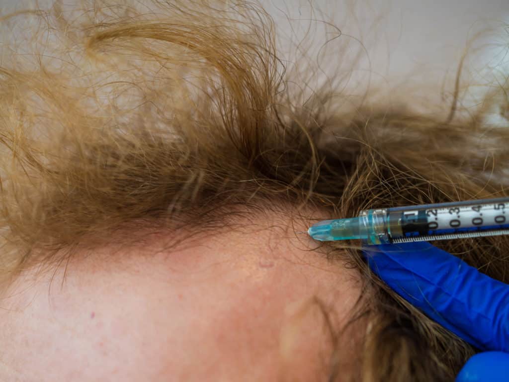 Leczenie łysienia - mezoterapia Hair Care 7